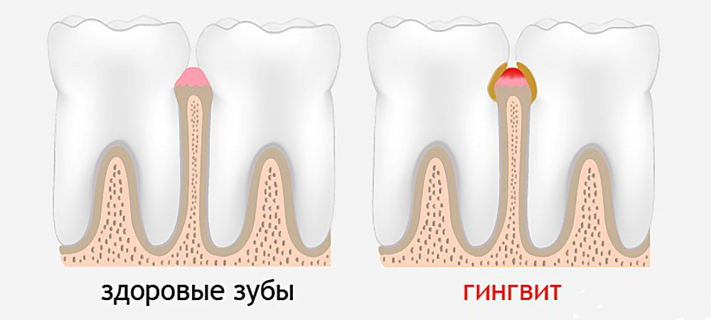 Клиническая картина отечной стадии гипертрофического гингивита