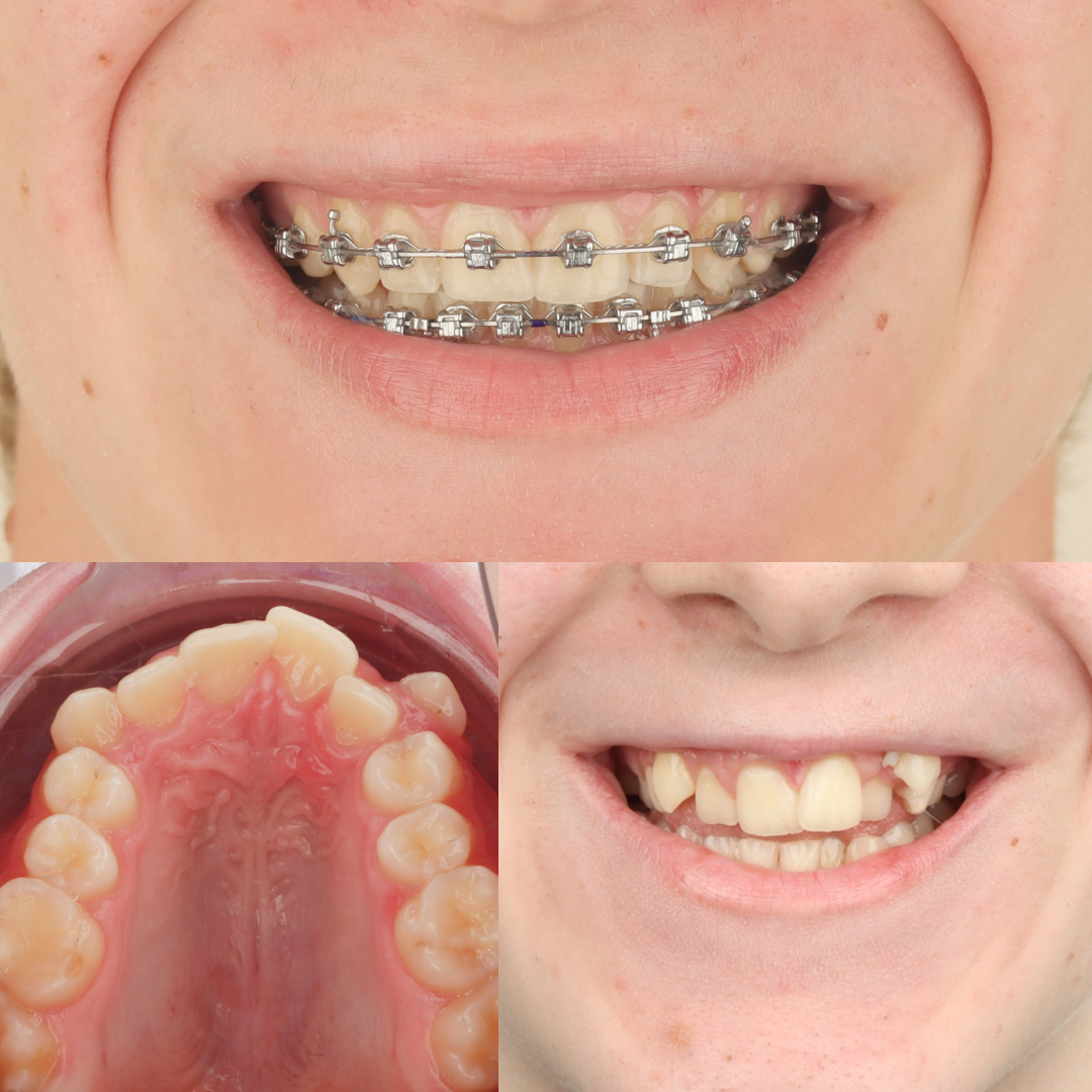 MARPE case result 9