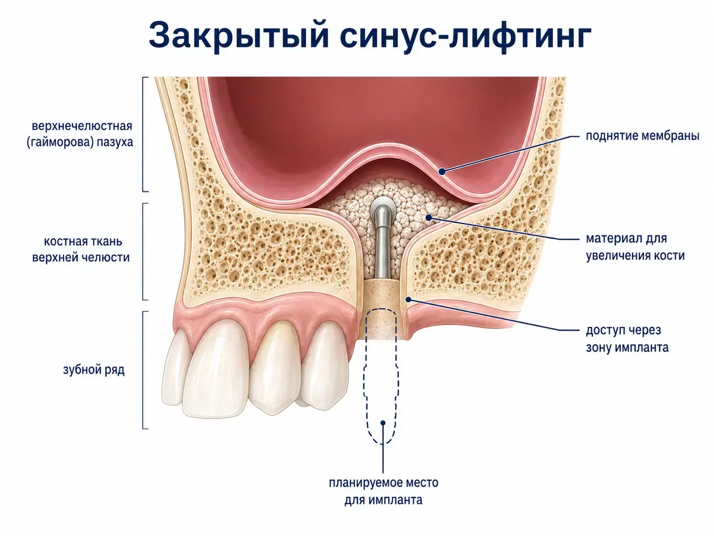 Закрытый синус-лифтинг