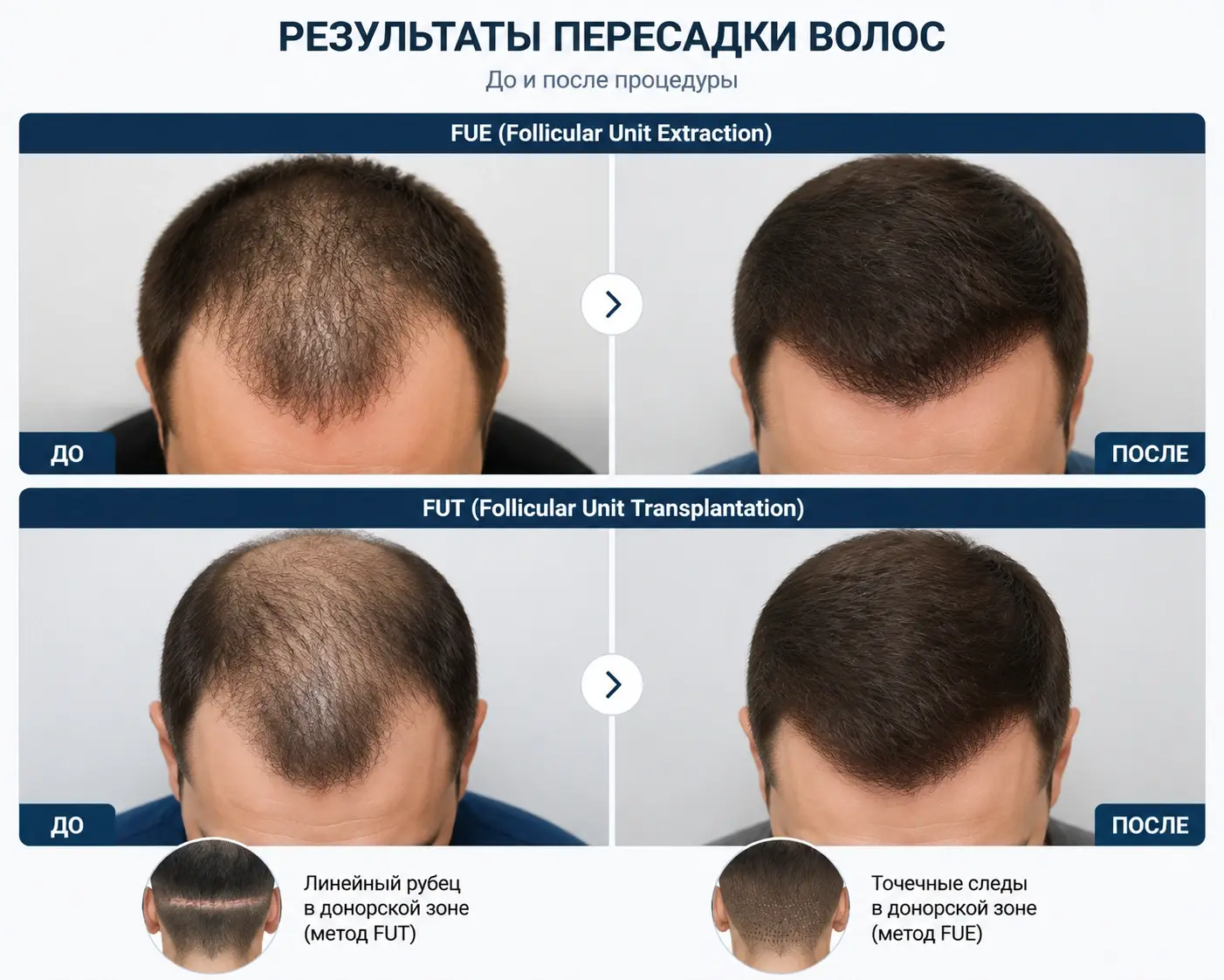Результаты пересадки волос FUE и FUT - до и после процедуры
