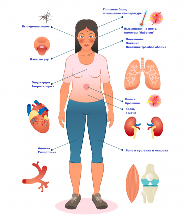 Признаки волчанки у женщин симптомы и лечение. Системная красная волчанка волчанка диагностика. Синдромы симптомы системной красной волчанки. Системная красная волчанка это аутоиммунное заболевание. Системная красная волчанка СКВ симптомы.