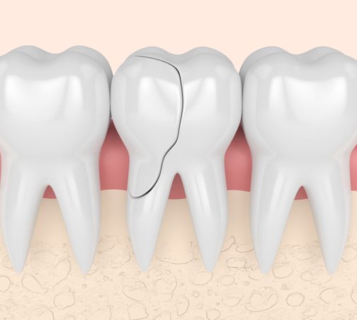 3 составляющие эмали зуба