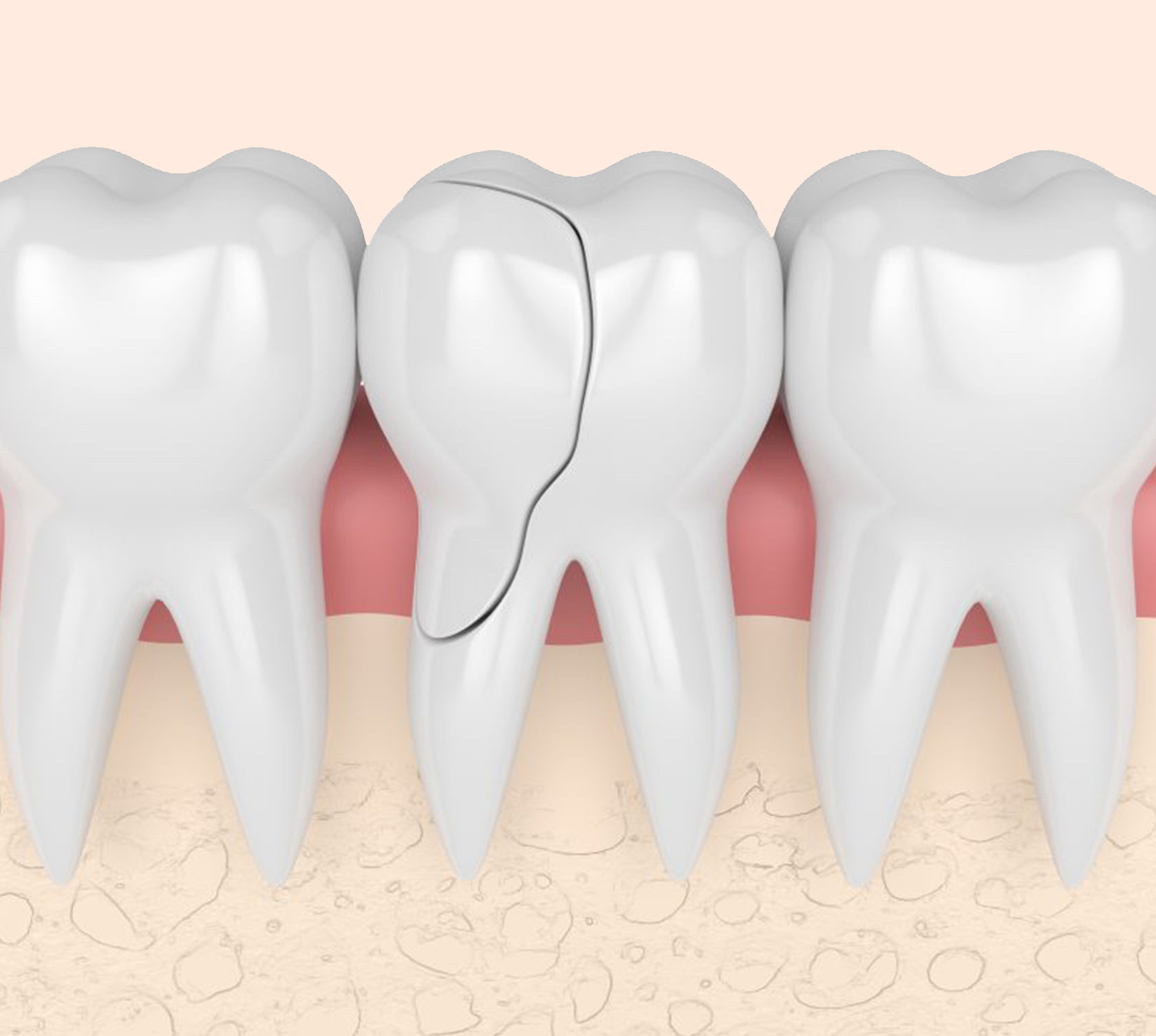 Как восстановить зубную эмаль: народные и профессиональные методики