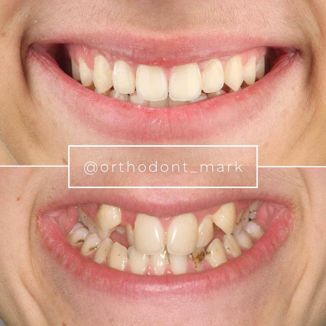 Before and after comparison illustrating a wider, more symmetrical smile