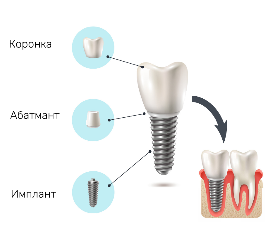 Дентальная имплантация презентация