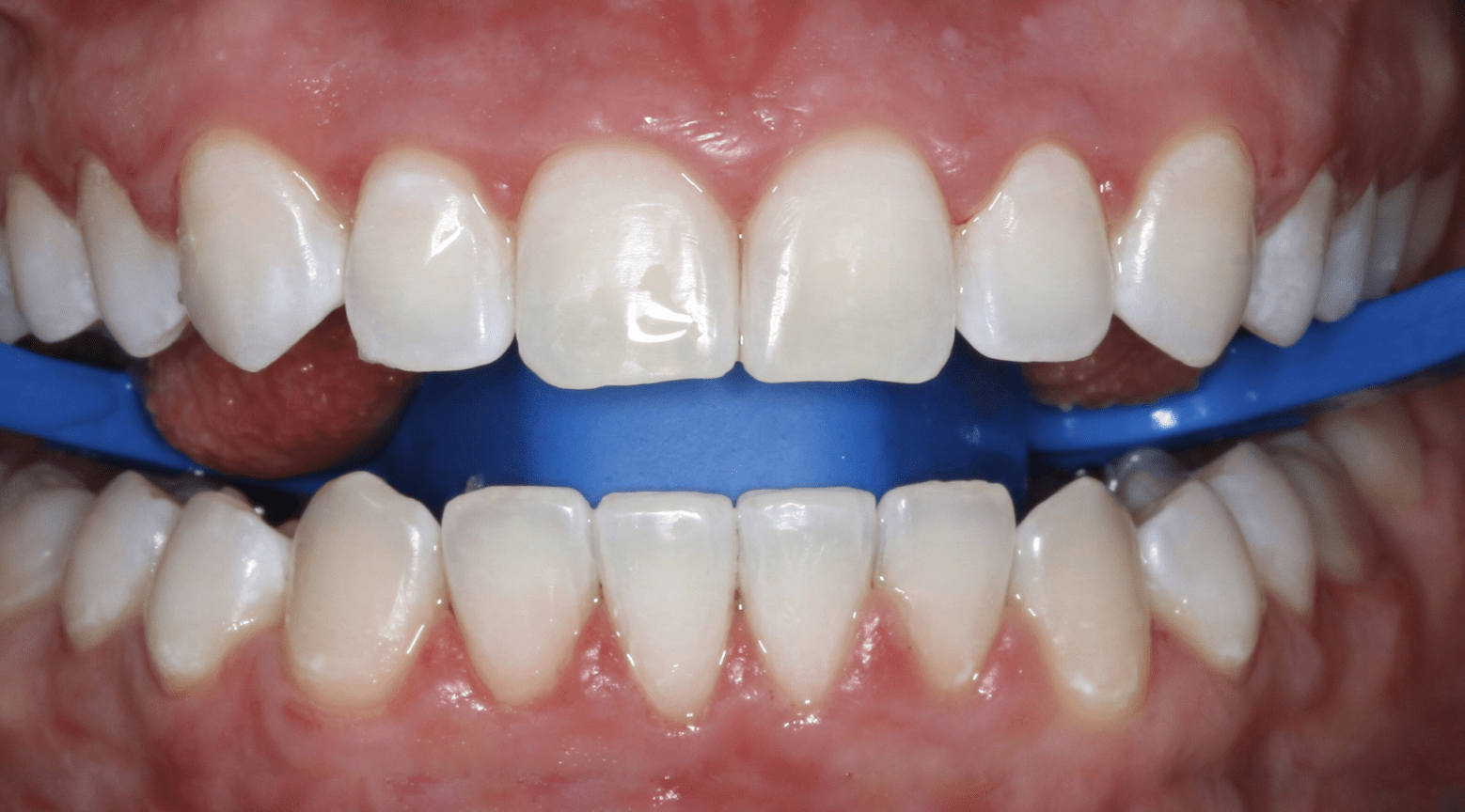 установка ретейнеров для исправление прикуса у взрослых в Москве