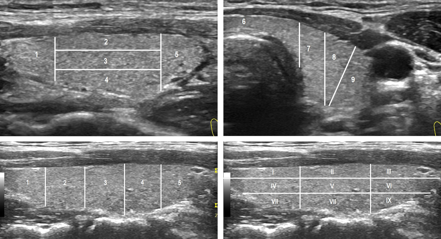 Сегменты щитовидной железы на УЗИ