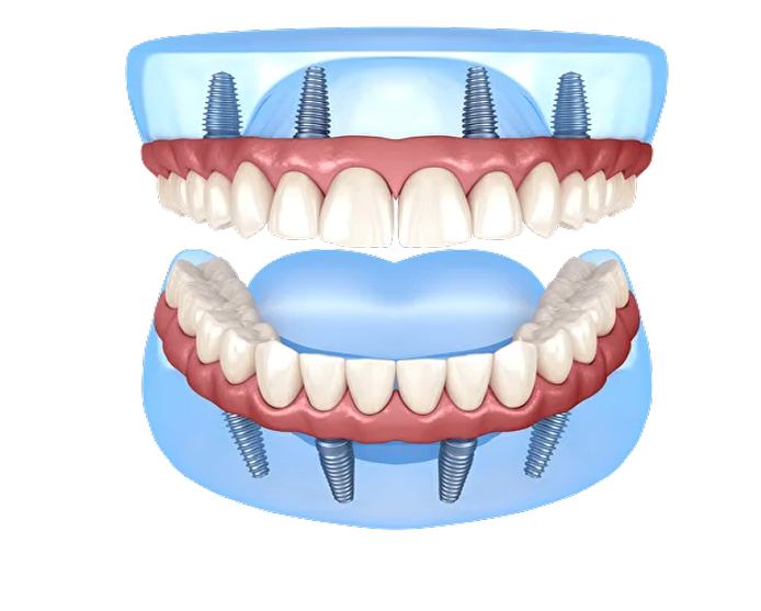 All-on-4 dental implants