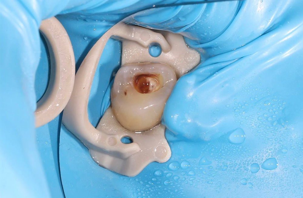 Удаление негерметичной пломбы и лечение вторичного кариеса зуба с поражением глубоких слоёв дентина