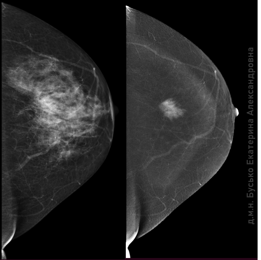 Маммография молочных желез как делают часто. Фиброаденома на маммографии. Контрастная маммография молочных желез. Рентген молочных желез маммография. Маммография дуктография.
