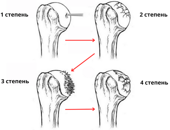 Полиартроз суставов что такое. Головка плечевой кости. Киста головки плечевой кости. Гнойный артрит плечевого сустава. Остеосклероз головки плечевой кости.