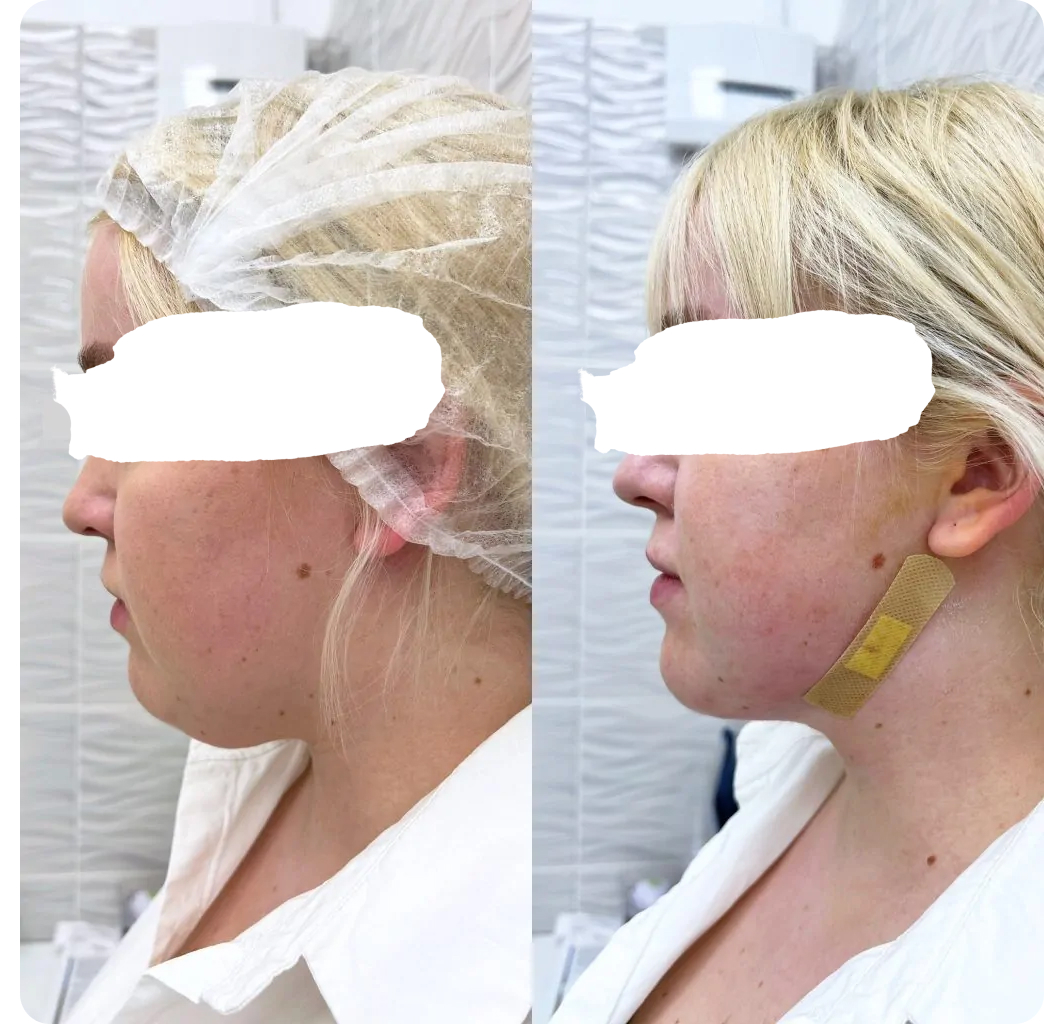 Липоредукция