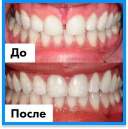 Установка имплантов в Дербенте. Имплантация при отсутствии одного зуба.