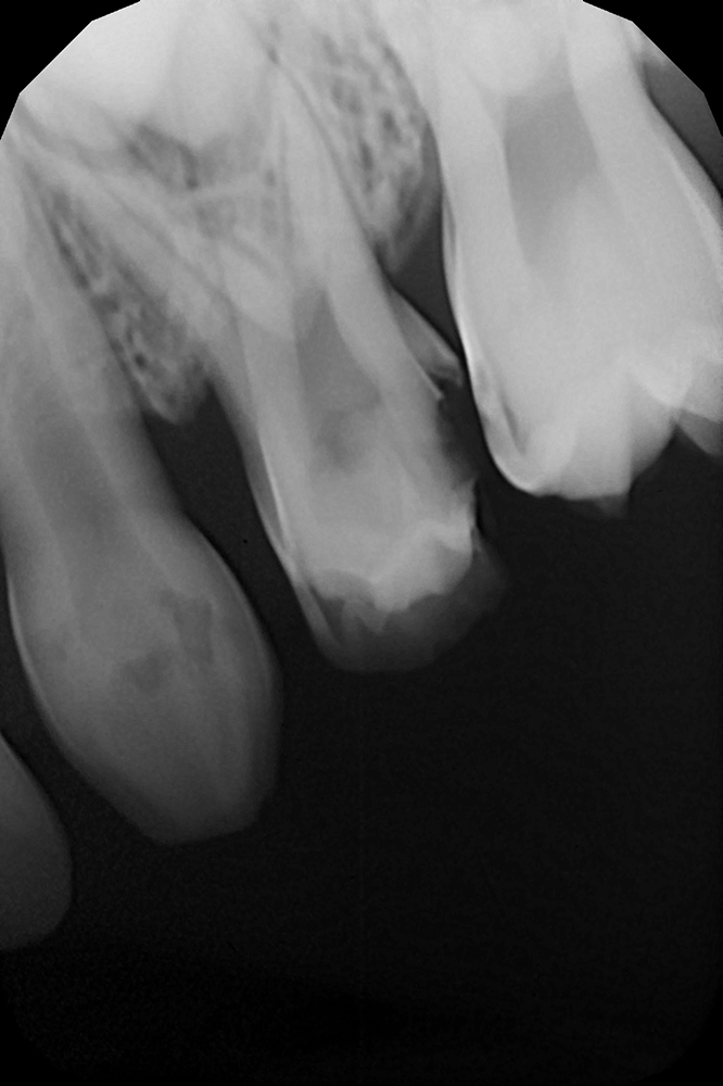Лечение осложнённого контактного кариеса с установкой долговечной коронки