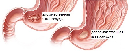 Стул при прободной язве