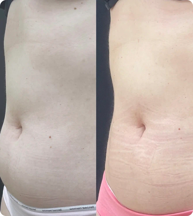 Безоперационная липосакция СПб