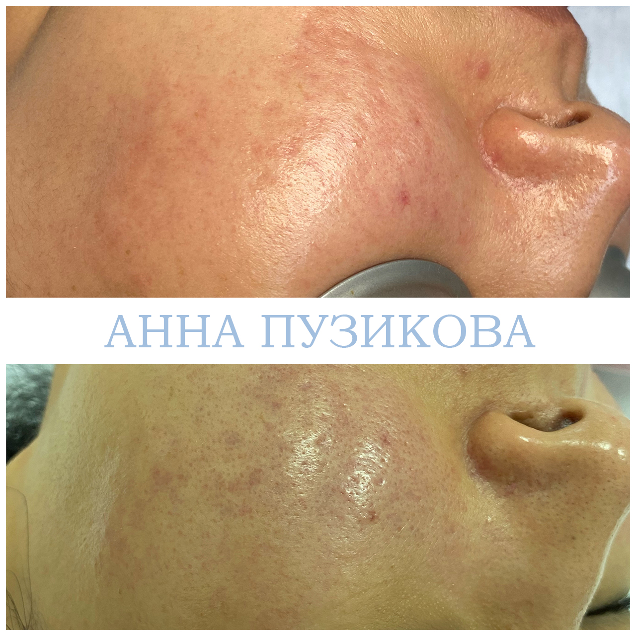 Результат удаления сосудистых звёздочек и купероза на лице с помощью фототерапии ClearLight IPL — врач-косметолог Пузикова Анна Анатольевна, Санкт-Петербург