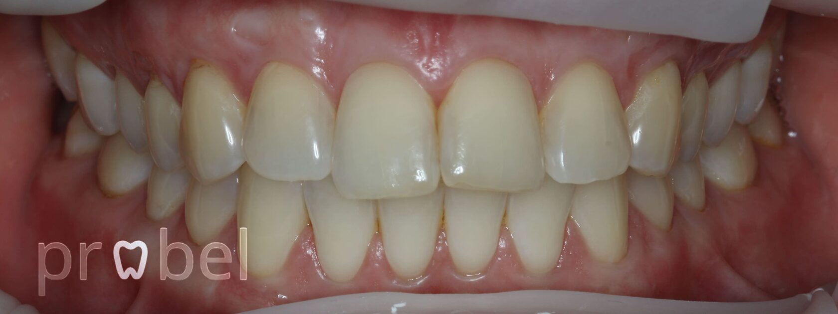 Результат операции по восстановлению десны в клинике Пробел
