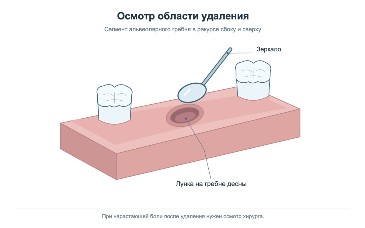Осмотр лунки после удаления зуба на учебной модели