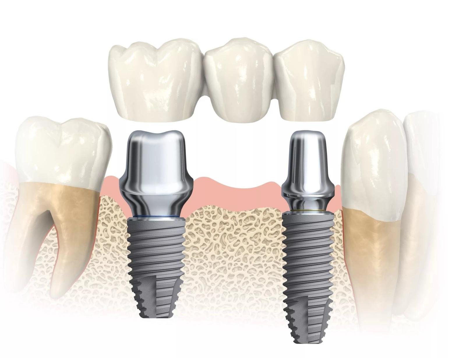 зубной мост на имплантах