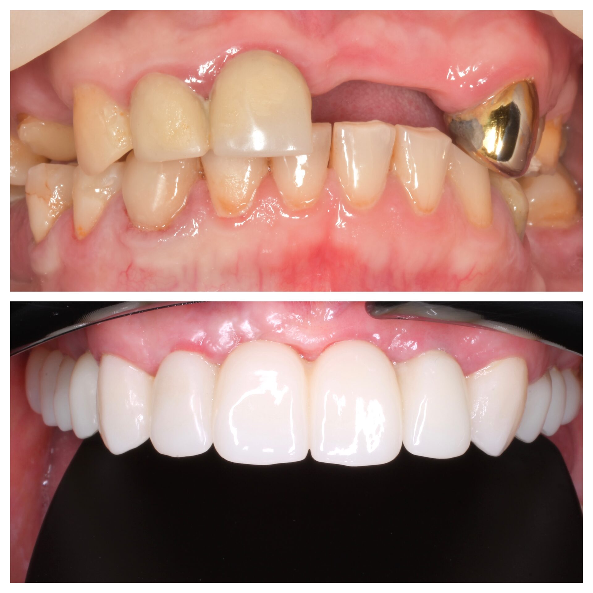 имплантация зубов чебоксары,имплантация зубов йошкар-ола,тотальная реабилитация на 6 имплантатах,протез несъемный в чебоксарах,имплантация зубов чебоксары,виниры чебоксары