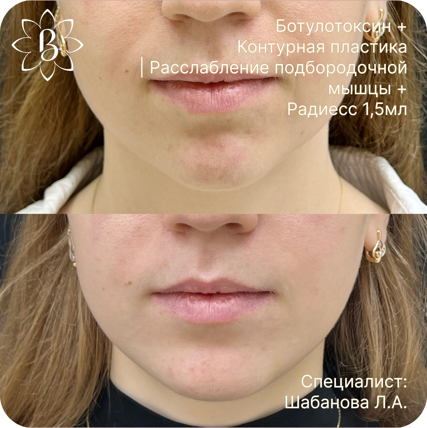 Александритовая лазерная эпиляция