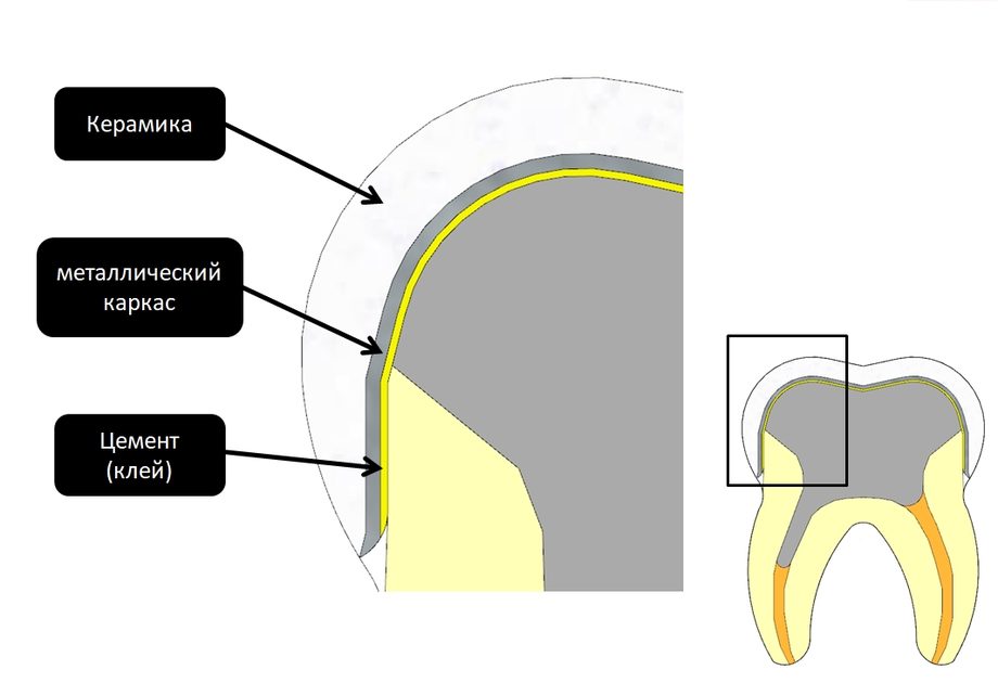 Сколько застывает цемент под коронкой зуба