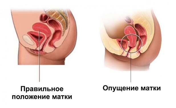 Ослабление мышц после родов