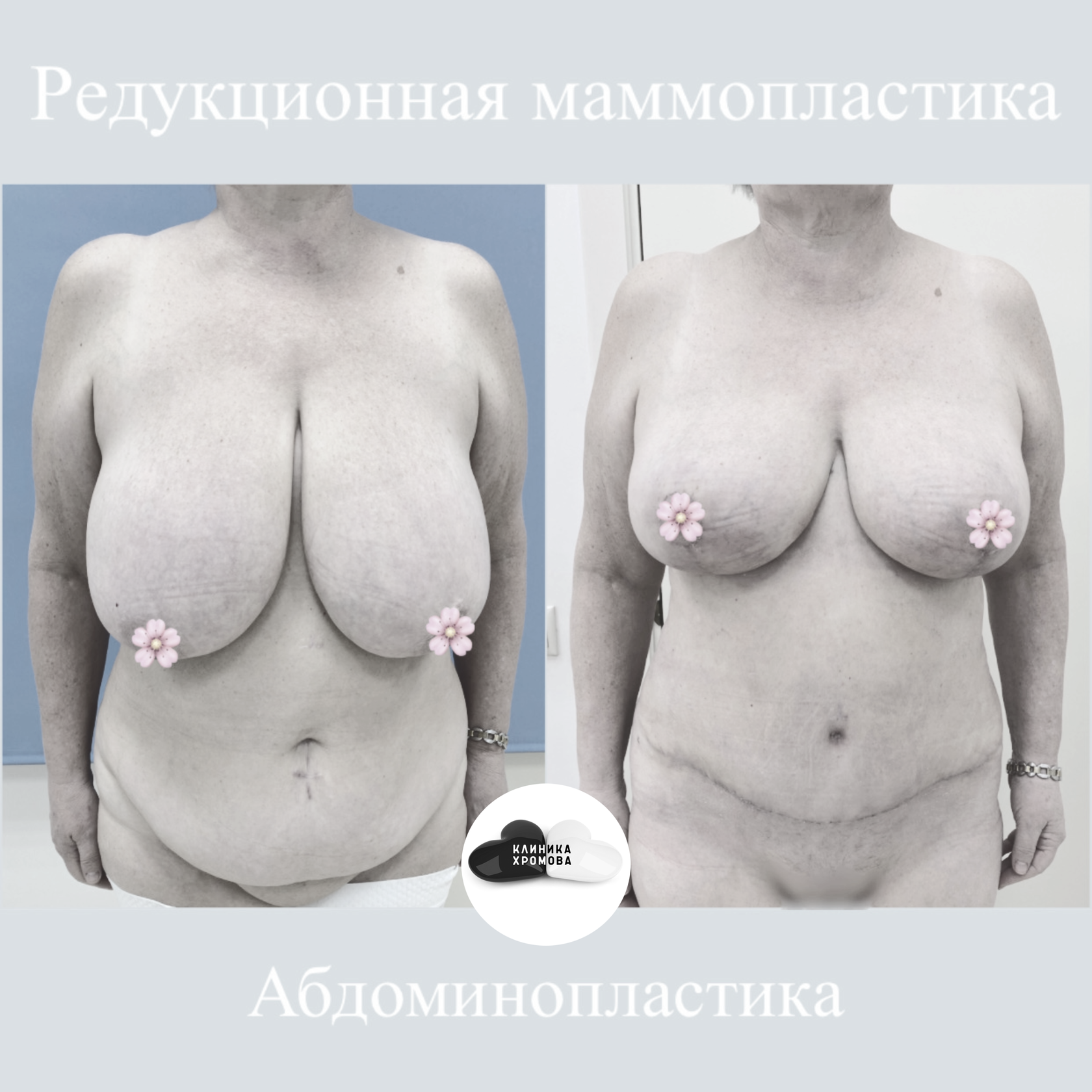 уменьшение груди у женщин в домашних условиях фото 24