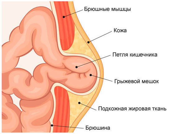 Пупочная грыжа состав
