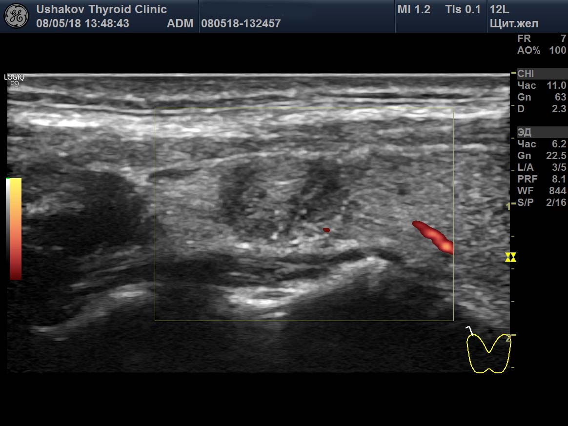 Щитовидная железа коллоидные узлы. Коллоидный узел щитовидной железы на УЗИ. Дополнительная долька щитовидной железы на УЗИ. УЗИ щитовидной железы измерение узла. Узел щитовидной железы УЗИ картина.