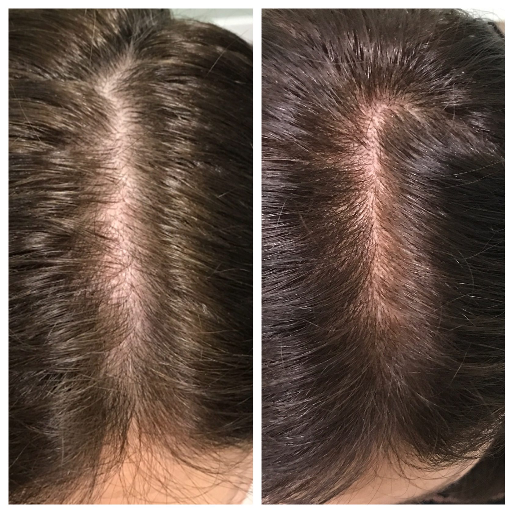 Prp For Hair Loss Reviews Hairstyles Ideas