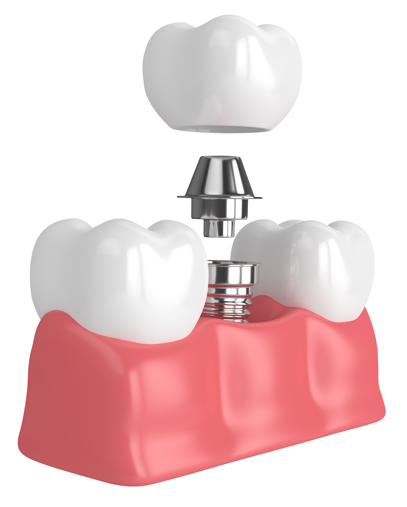 Имплантация в Калуге по выгодным ценам в частной стоматологический ...