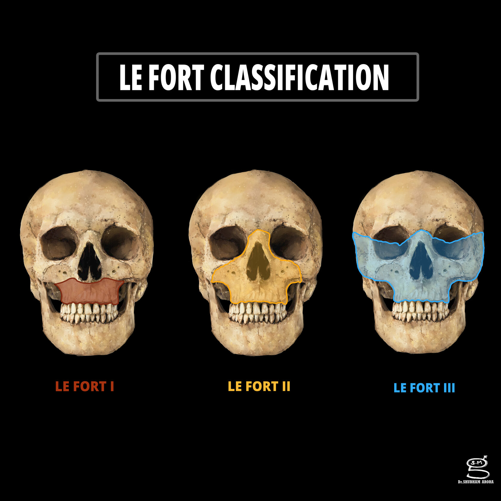 Класифікація травм середньої зони обличчя за Ле Фортом