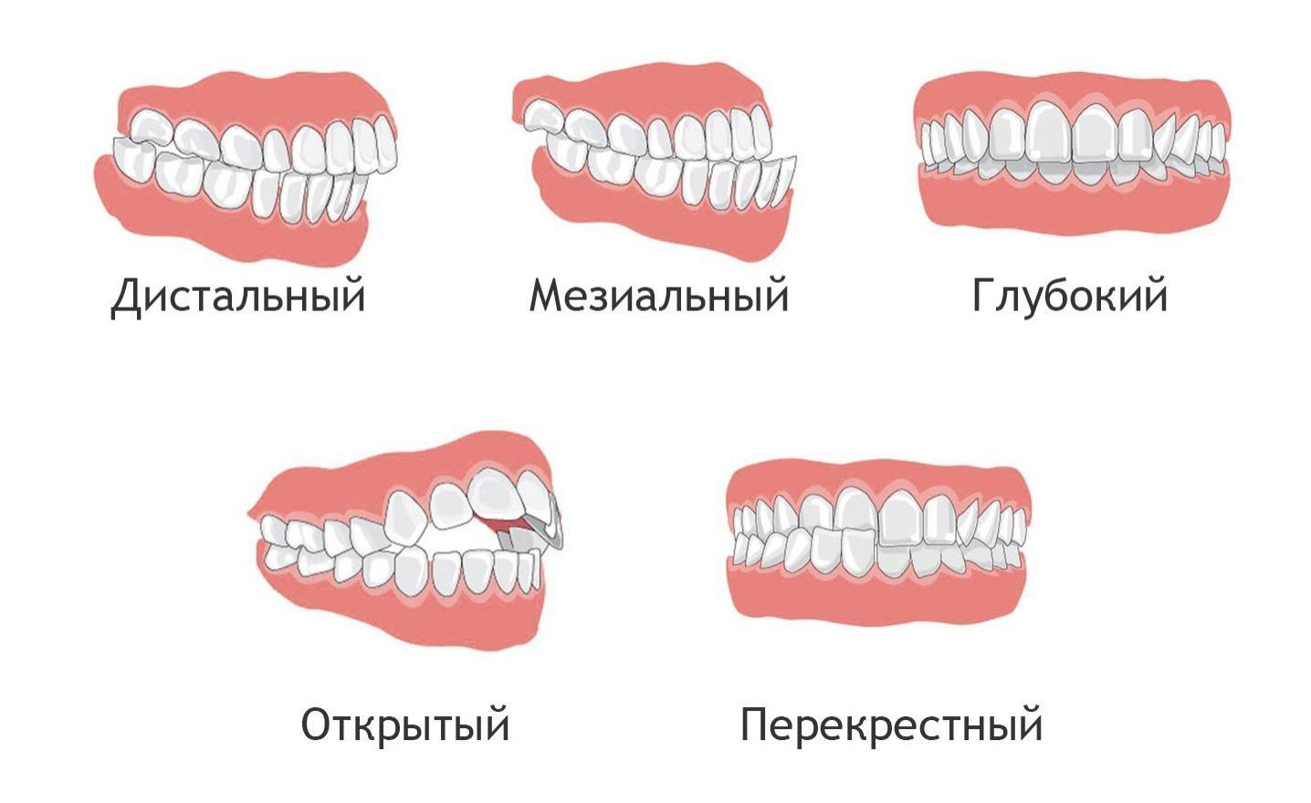 Элайнеры в Перми - Клиника Аллада