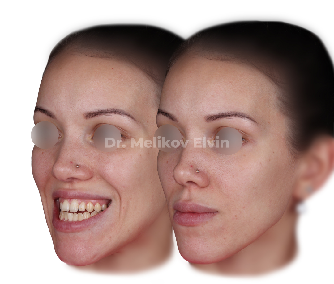 Мезиальный прикус