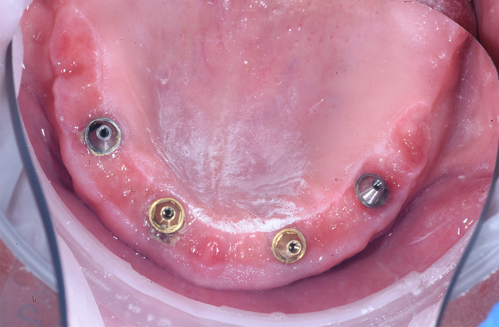 Профессиональная чистка съемного зубного протеза на четырех имплантах