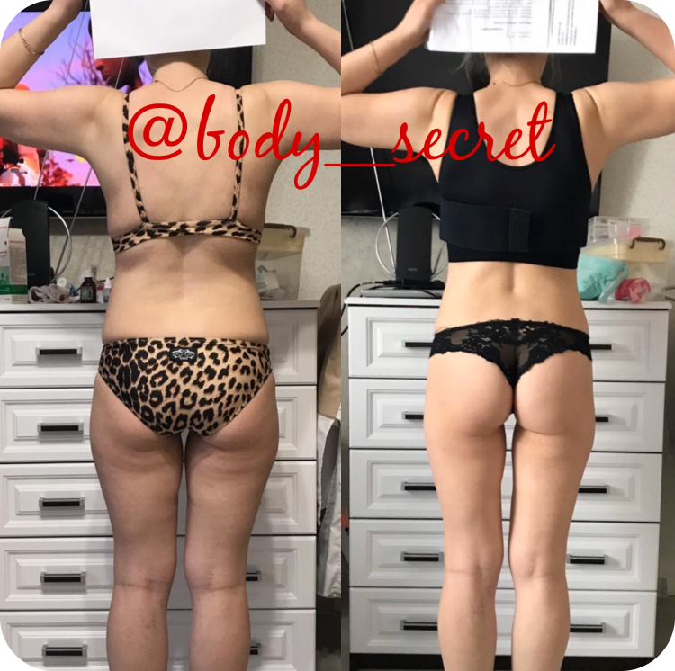 Body secret. Массаж ингибитором жира до и после. Ингибитор жира Результаты. Артем щогла пластик боди.
