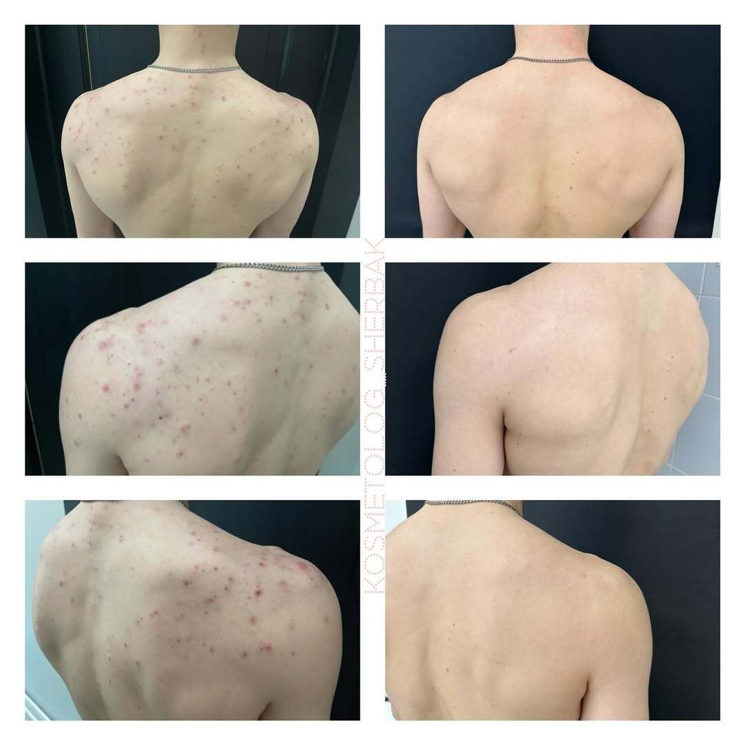 Лечение акне у женщины в клинике PradusCOSMO, СПб. До и после процедуры