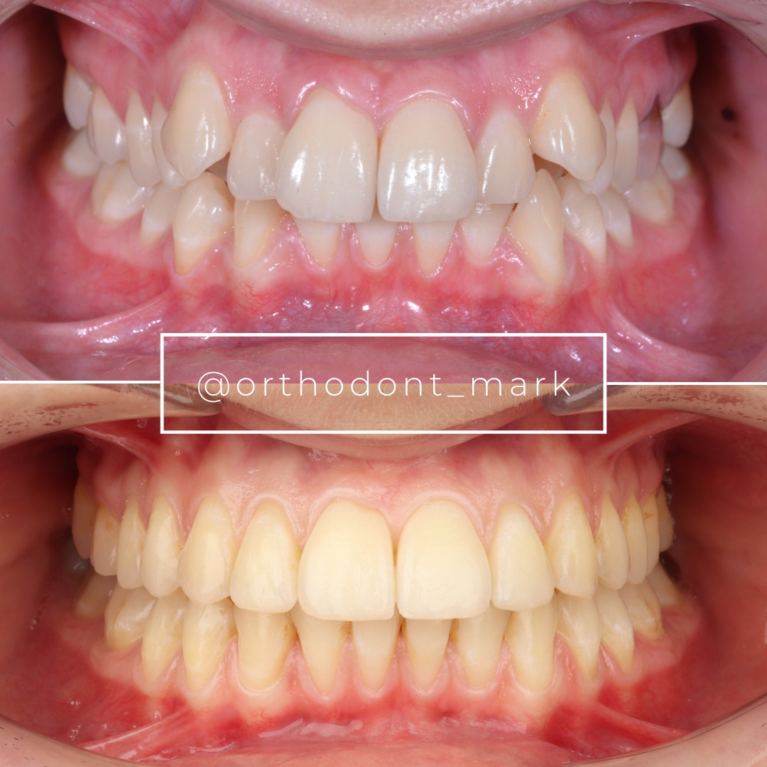 Stage showing IPR-assisted alignment of the canines in progress — photo 2 of 3