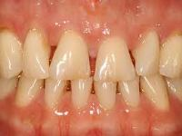 Признаки заболевания дёсен