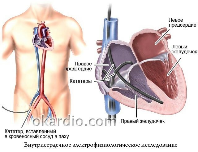 Электрофизиологическое исследование сердца презентация