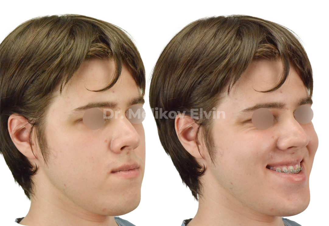 Мезиальный прикус