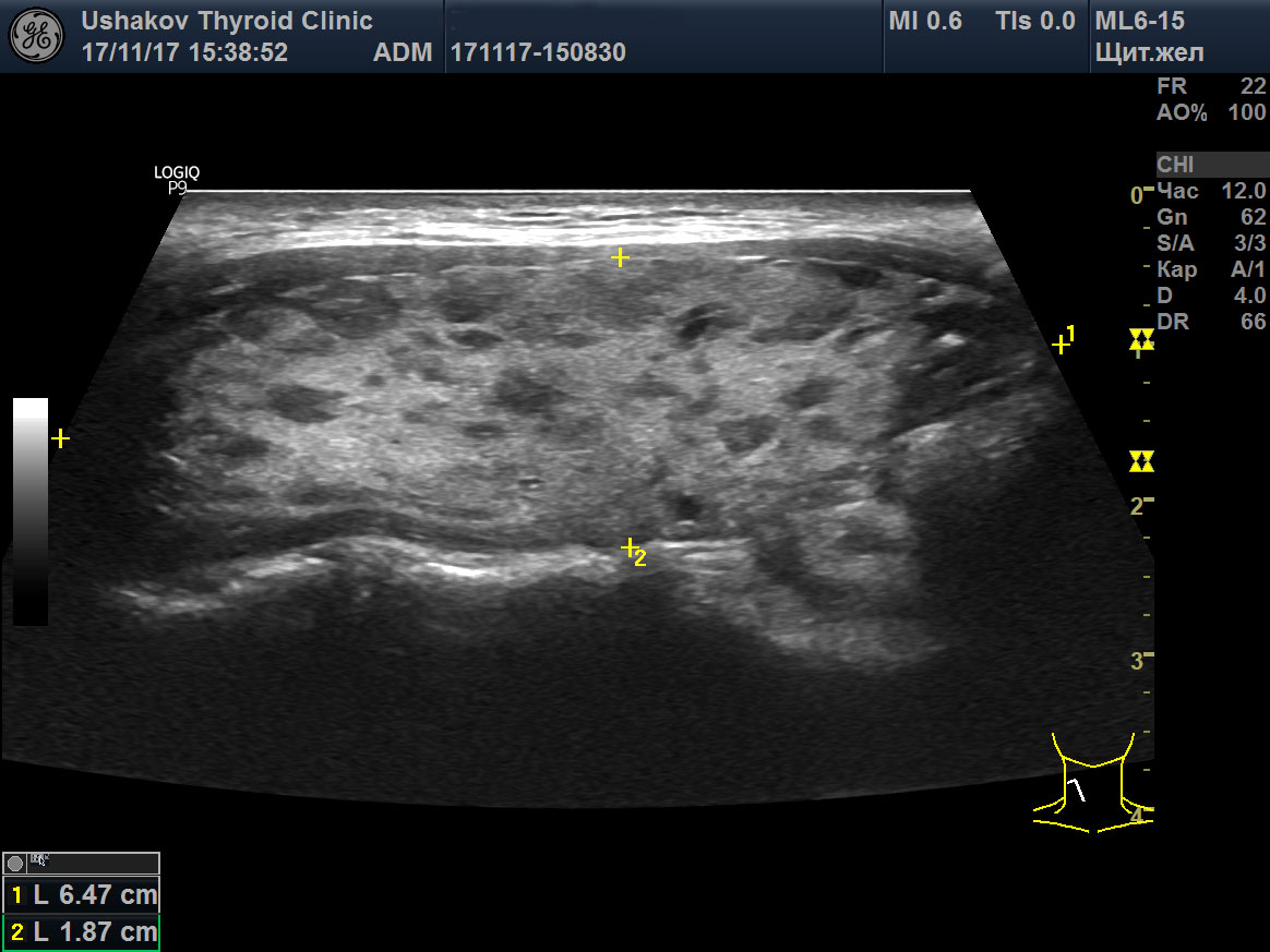 Гипоэхогенная щитовидная железа