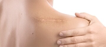 шрамы и рубцы причины появления и их виды