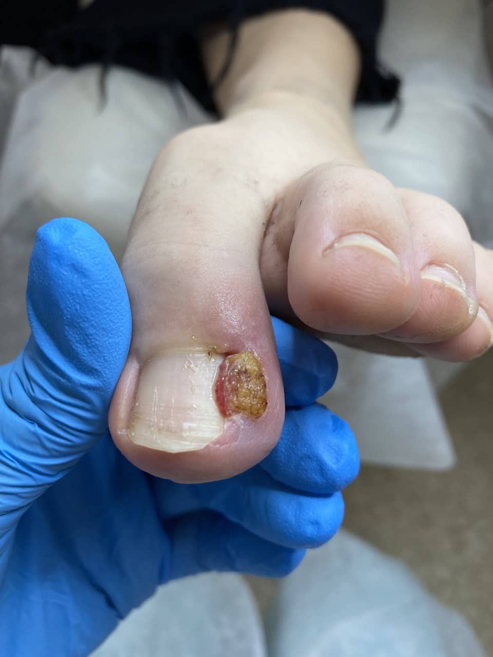 обработка ногтей живое мясо