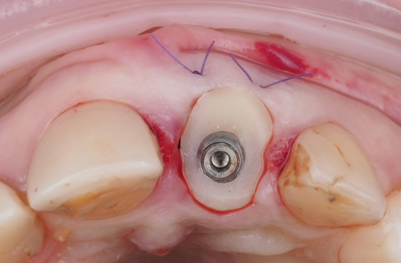 индивидуальный формирователь десны