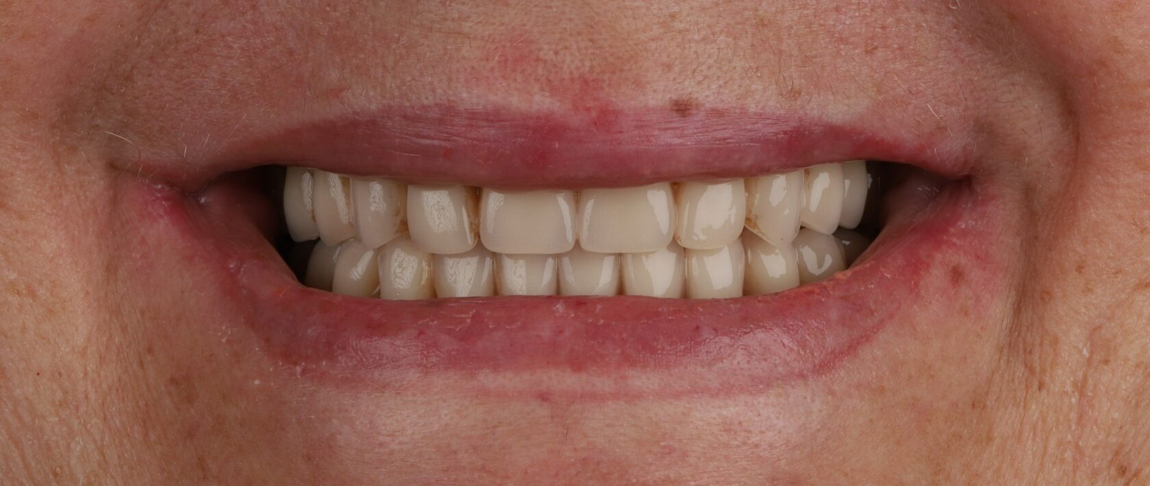 All-on-4, All-in-4 имплантация, протезирование, вернуть зубы, протезирование на имплантах, всё-на-4, все-на-четырех, протезирование зубов