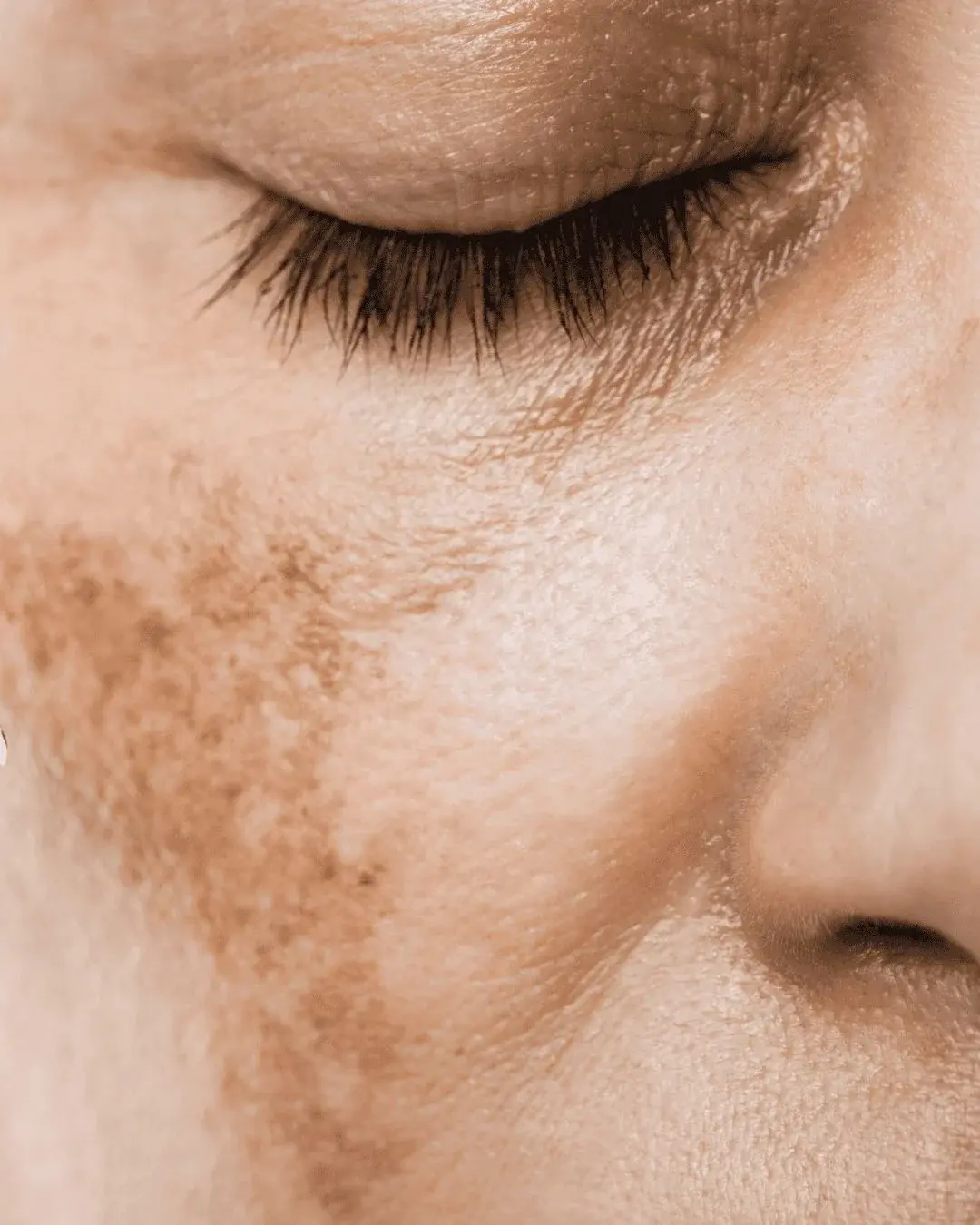 Пигментация