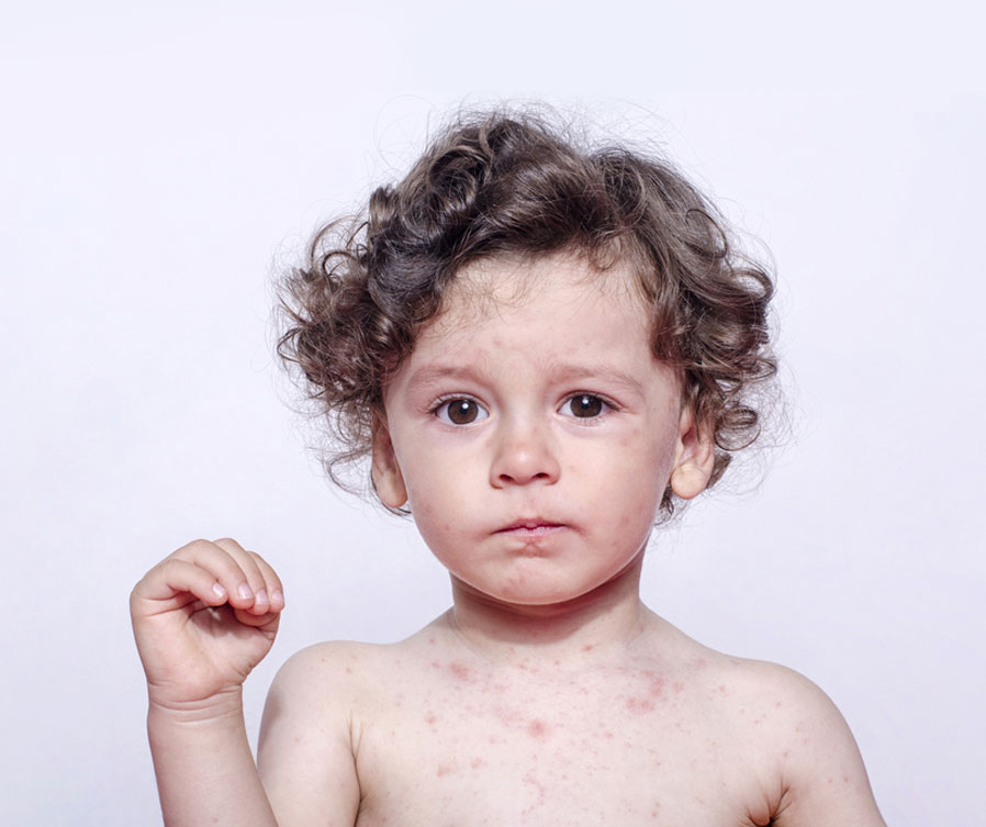 Атопический дерматит